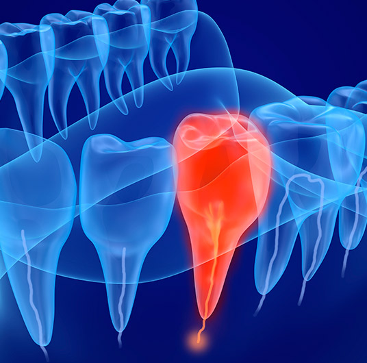 Endodoncia-airdental-clinica-barcelona