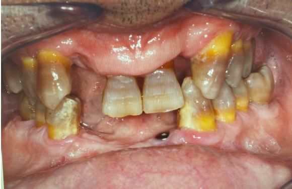 Rehabilitación integral all on four sup e implantes inferiores