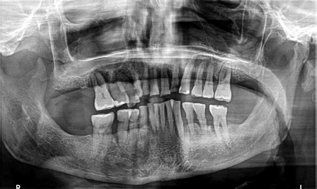 Rehabilitación periodontal, implantes y prótesis