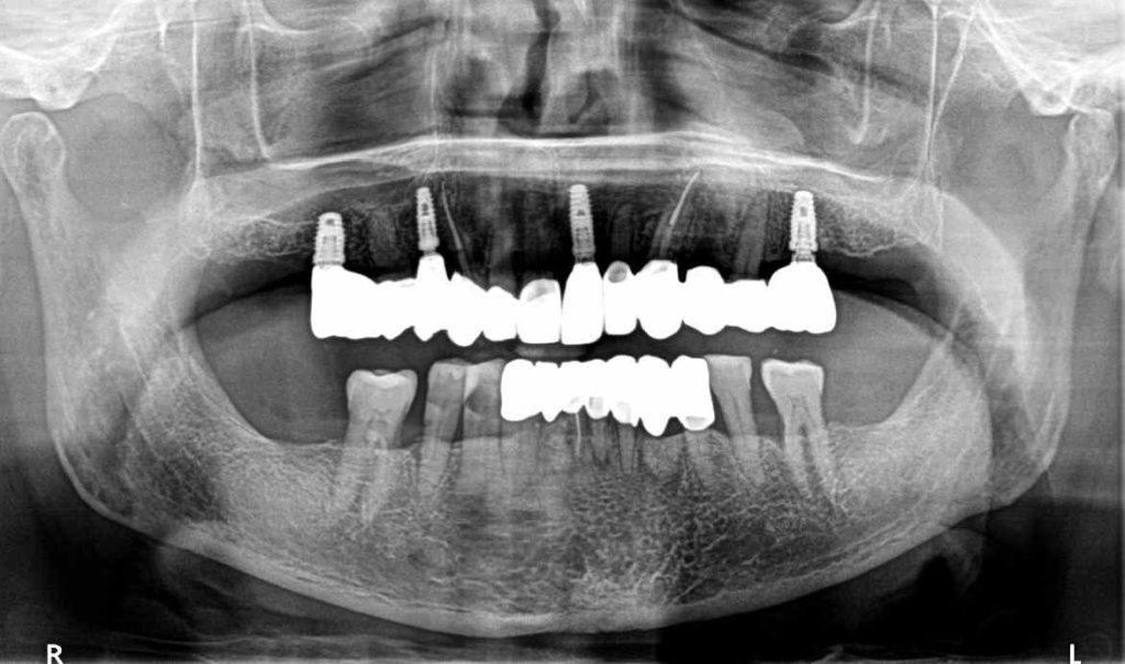 Rehabilitación periodontal, implantes y prótesis