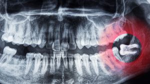 cirugía maxilofacial de la muela del juicio riesgos